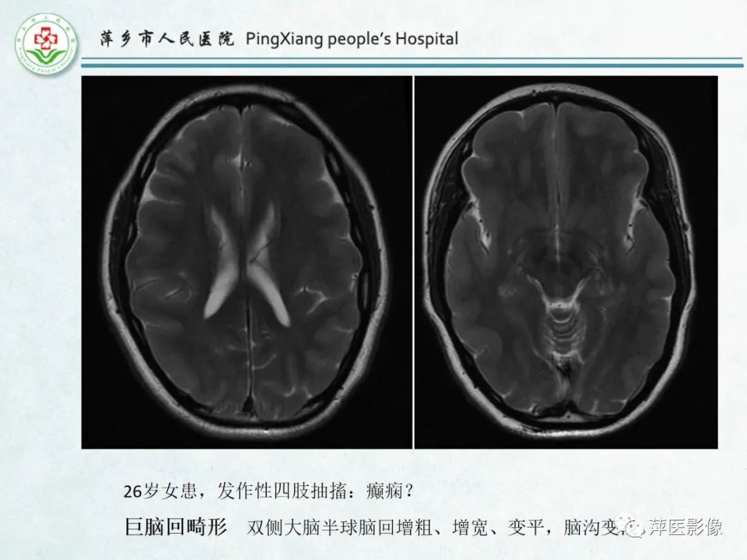 影像PPT - 【PPT】颅脑先天性畸形及发育异常的影像诊断-31