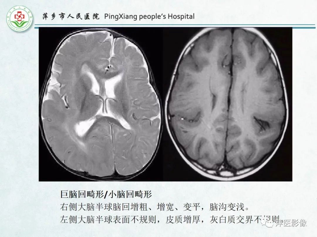 影像PPT - 【PPT】颅脑先天性畸形及发育异常的影像诊断-30