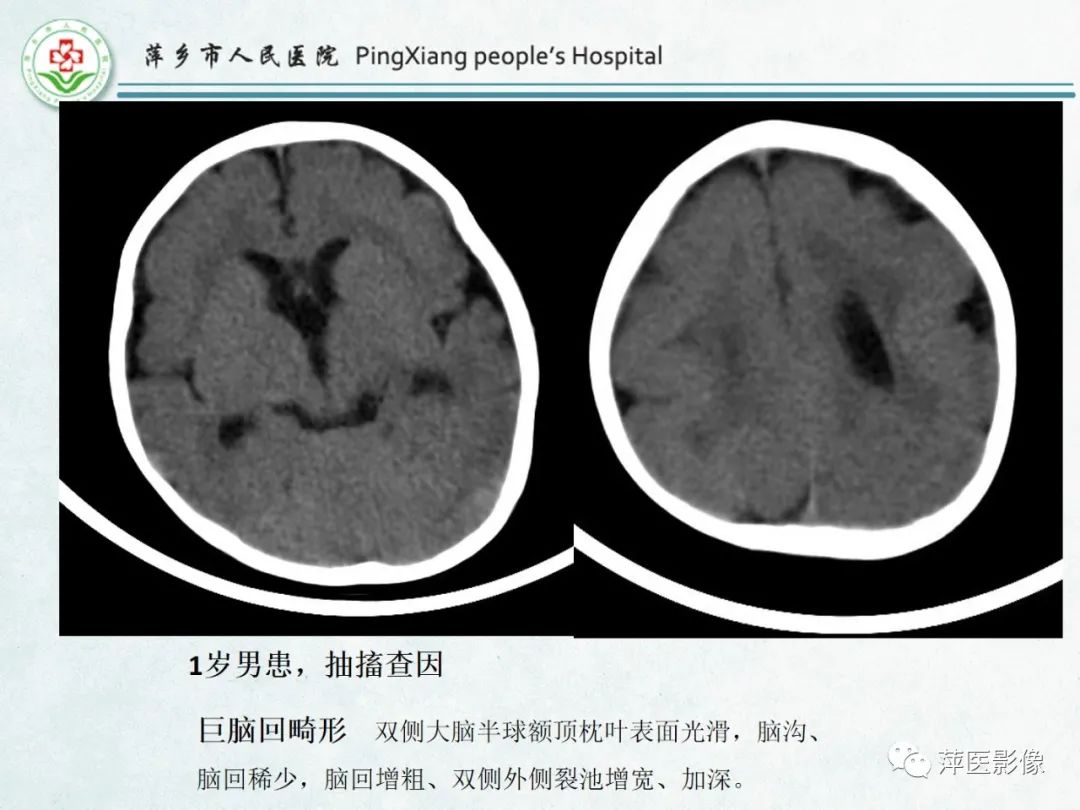 影像PPT - 【PPT】颅脑先天性畸形及发育异常的影像诊断-32