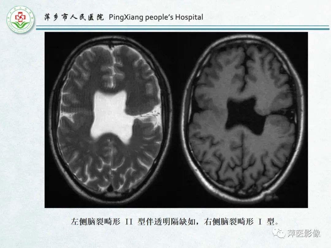 影像PPT - 【PPT】颅脑先天性畸形及发育异常的影像诊断-35