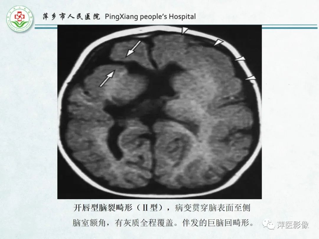 影像PPT - 【PPT】颅脑先天性畸形及发育异常的影像诊断-36
