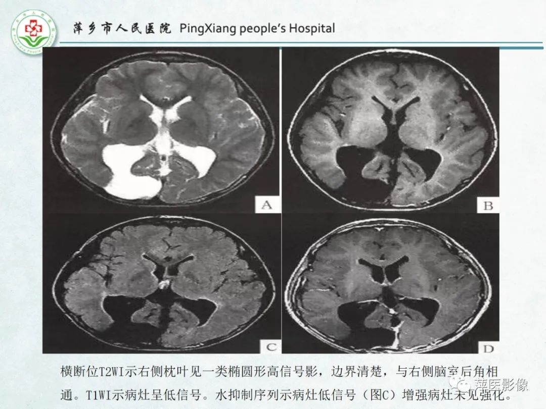 影像PPT - 【PPT】颅脑先天性畸形及发育异常的影像诊断-37