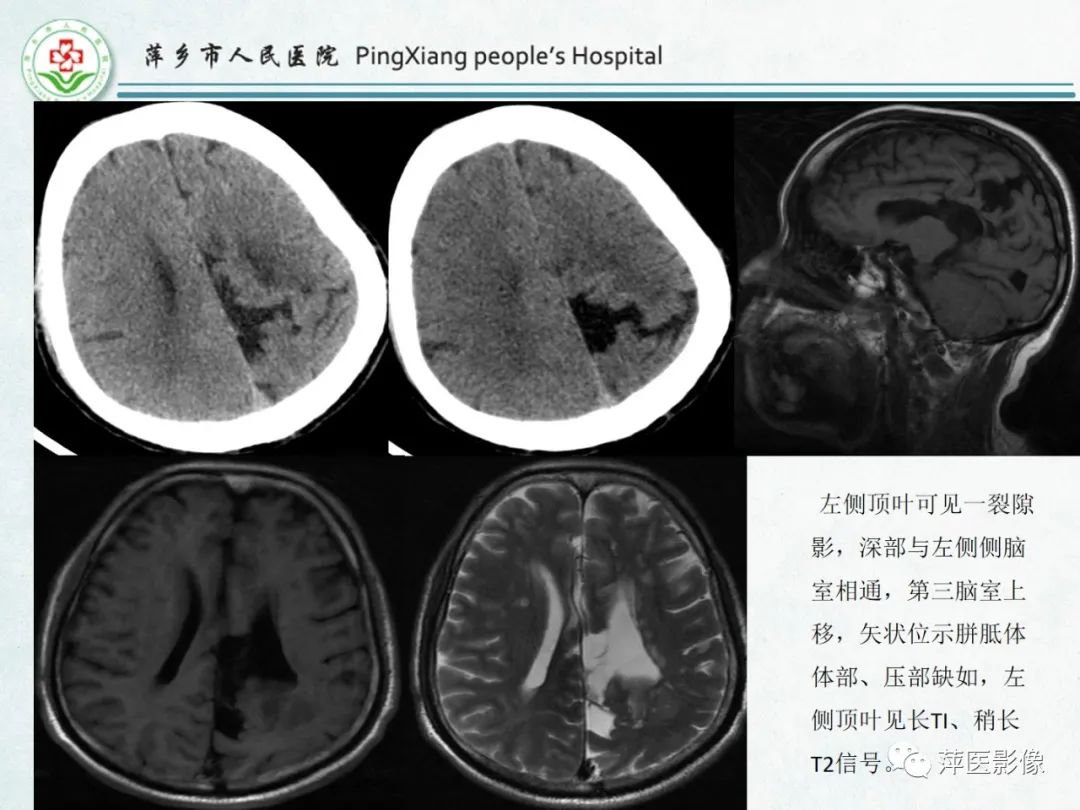 影像PPT - 【PPT】颅脑先天性畸形及发育异常的影像诊断-38