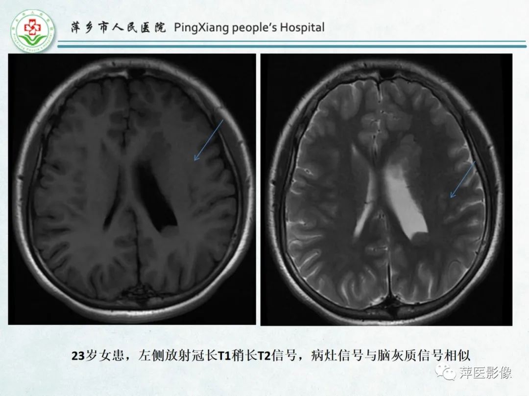 影像PPT - 【PPT】颅脑先天性畸形及发育异常的影像诊断-40