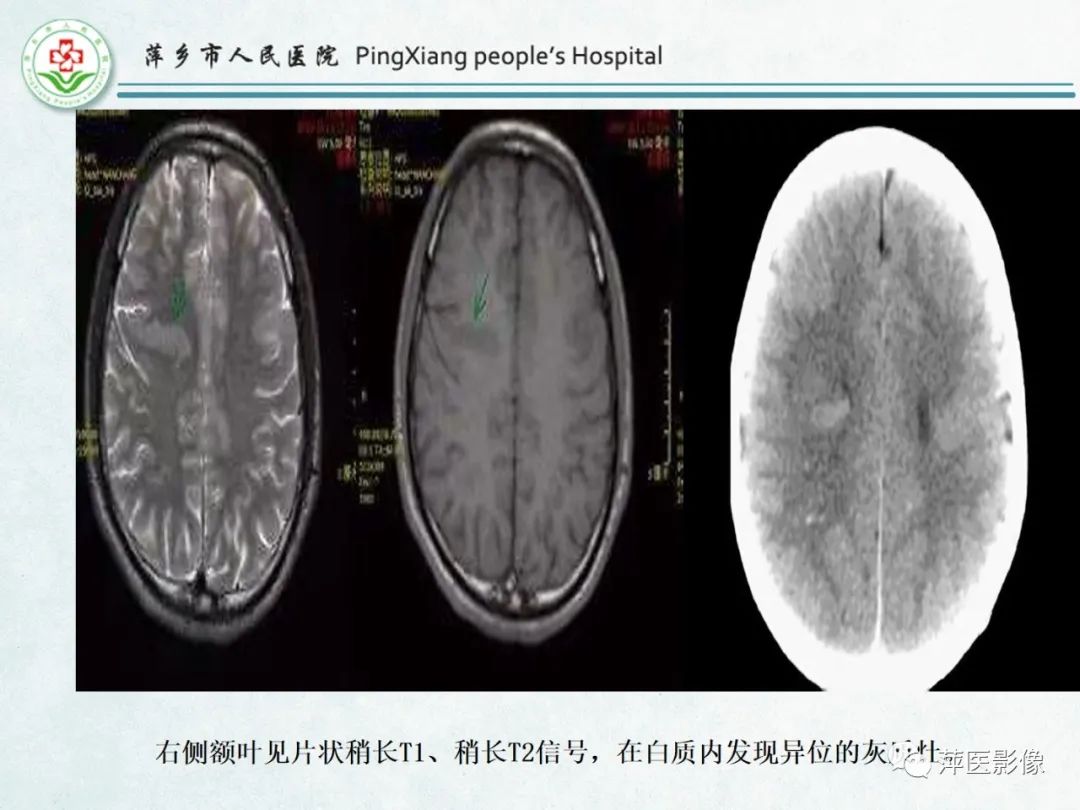 影像PPT - 【PPT】颅脑先天性畸形及发育异常的影像诊断-41