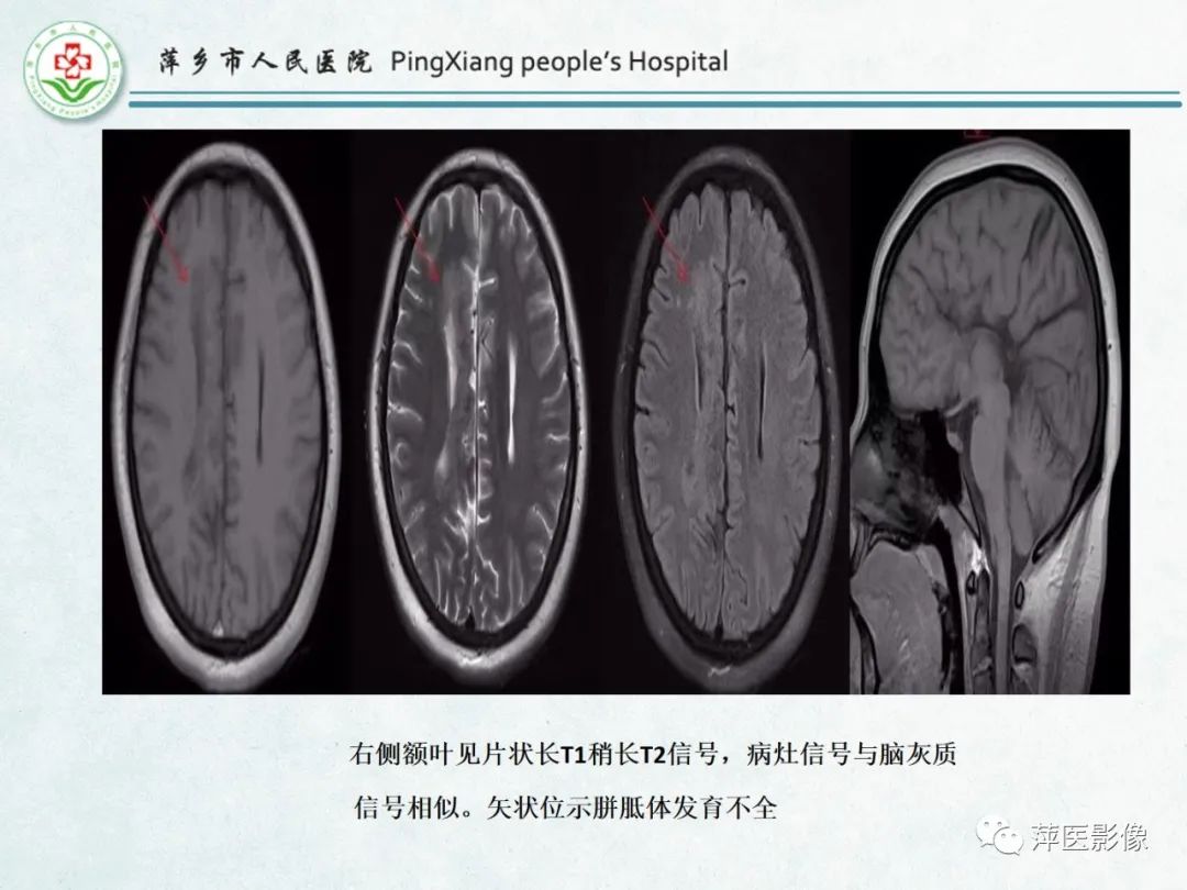 影像PPT - 【PPT】颅脑先天性畸形及发育异常的影像诊断-42