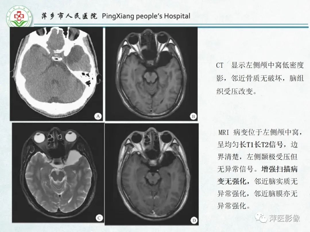 影像PPT - 【PPT】颅脑先天性畸形及发育异常的影像诊断-45