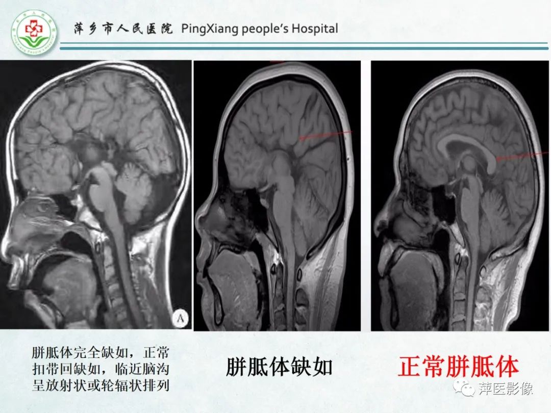影像PPT - 【PPT】颅脑先天性畸形及发育异常的影像诊断-2