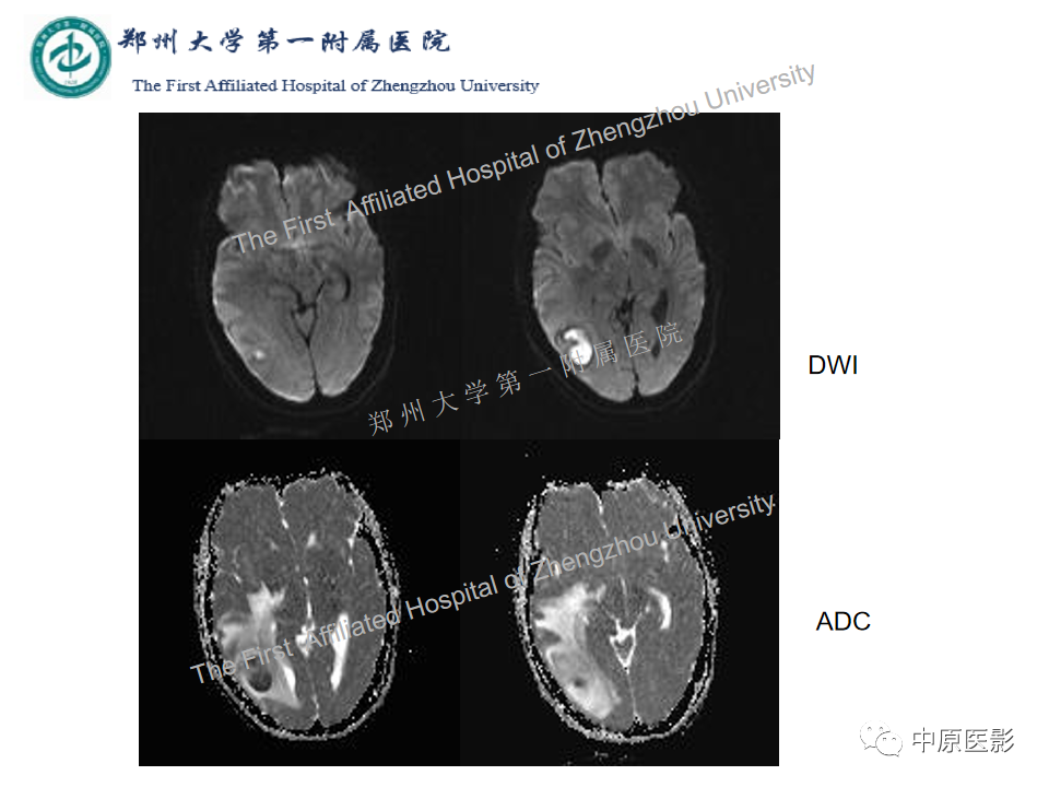 影像PPT - 【病例】脑脓肿1例MR影像-5