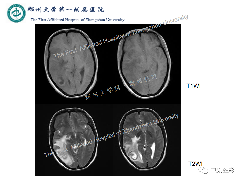 影像PPT - 【病例】脑脓肿1例MR影像-3