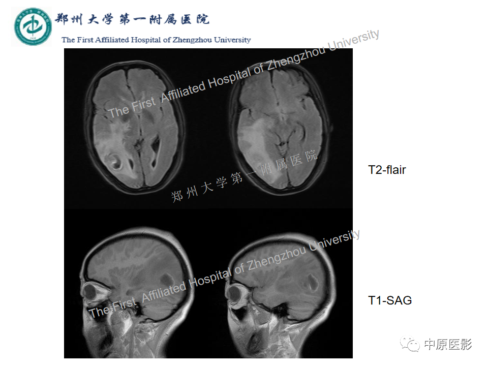影像PPT - 【病例】脑脓肿1例MR影像-4