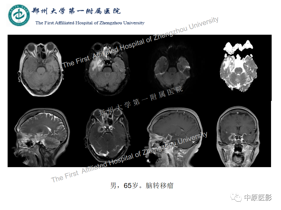 影像PPT - 【病例】脑脓肿1例MR影像-16
