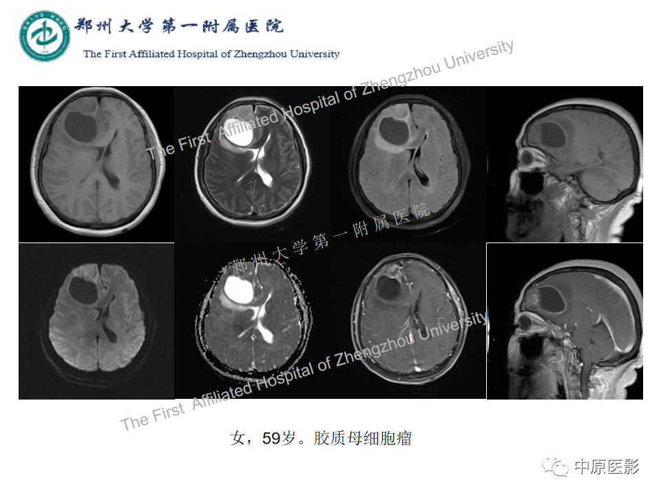 影像PPT - 【病例】脑脓肿1例MR影像-1