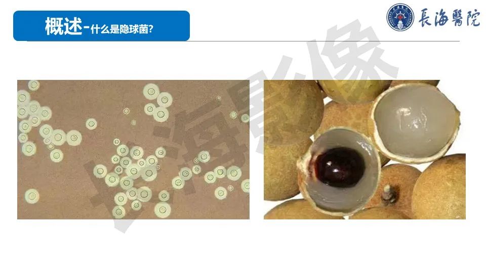 影像PPT - 【PPT】肺部隐球菌感染CT诊断-3