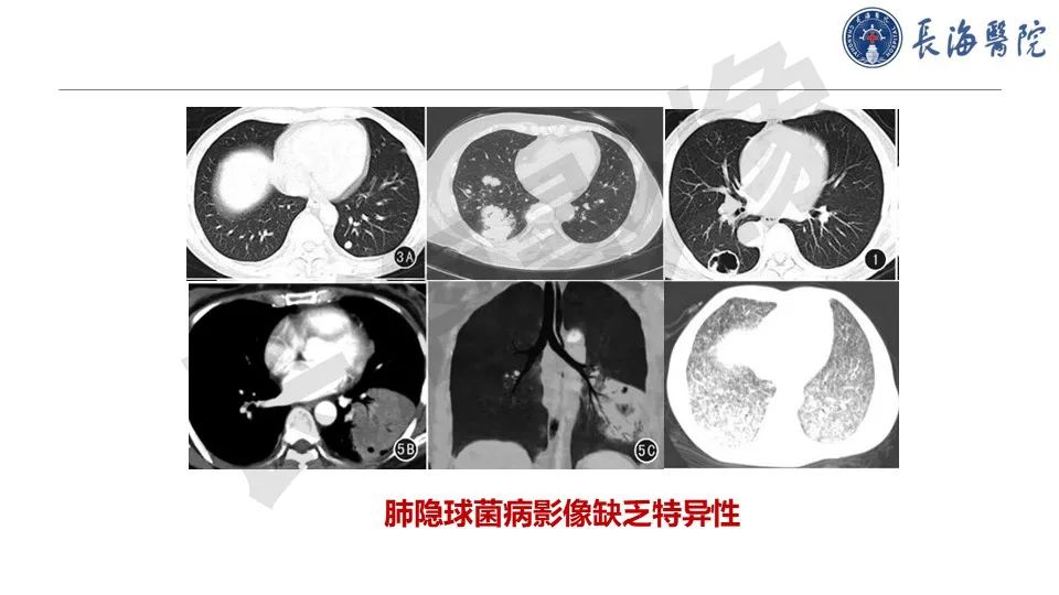 影像PPT - 【PPT】肺部隐球菌感染CT诊断-12