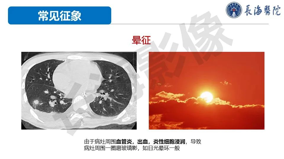 影像PPT - 【PPT】肺部隐球菌感染CT诊断-13