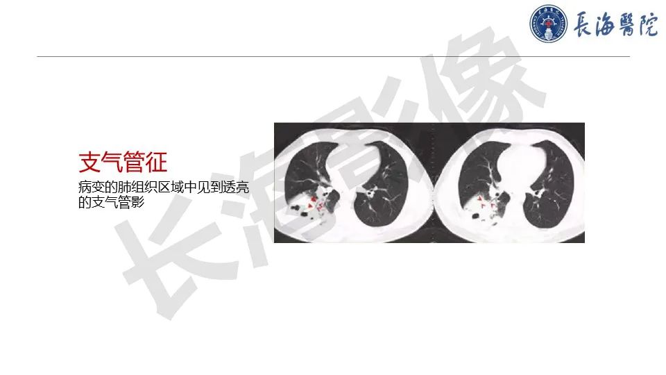影像PPT - 【PPT】肺部隐球菌感染CT诊断-14