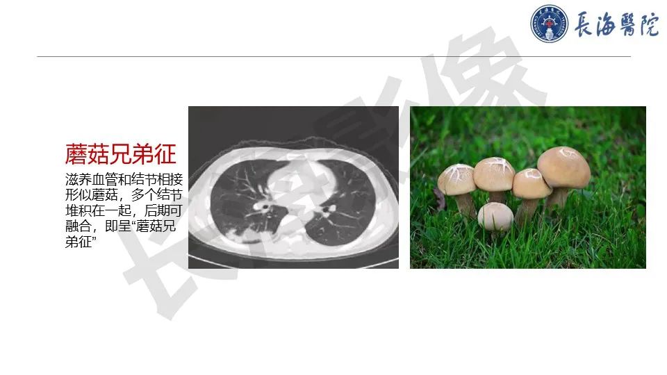 影像PPT - 【PPT】肺部隐球菌感染CT诊断-15