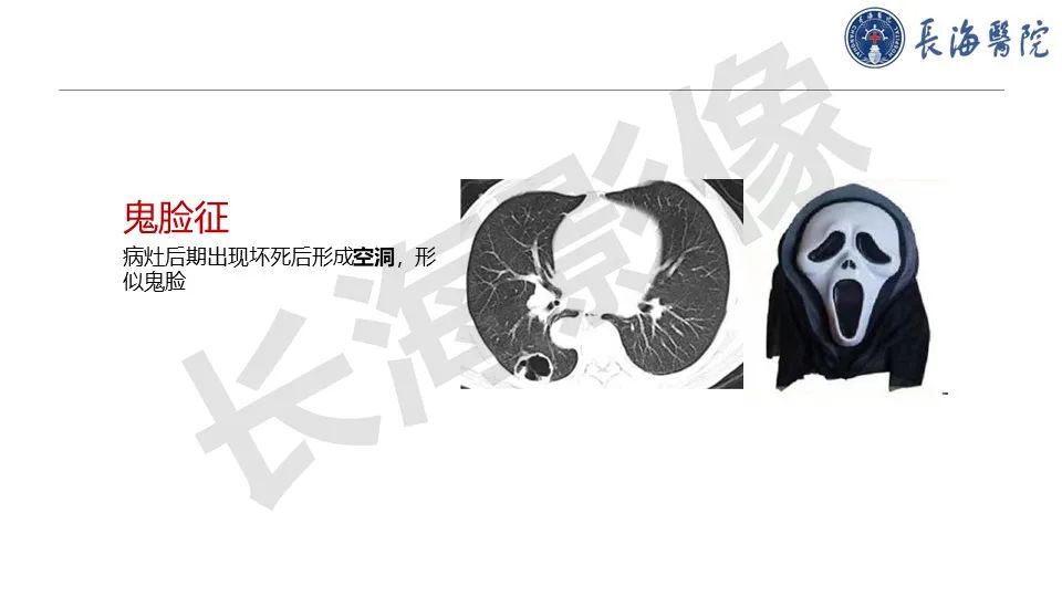 影像PPT - 【PPT】肺部隐球菌感染CT诊断-16