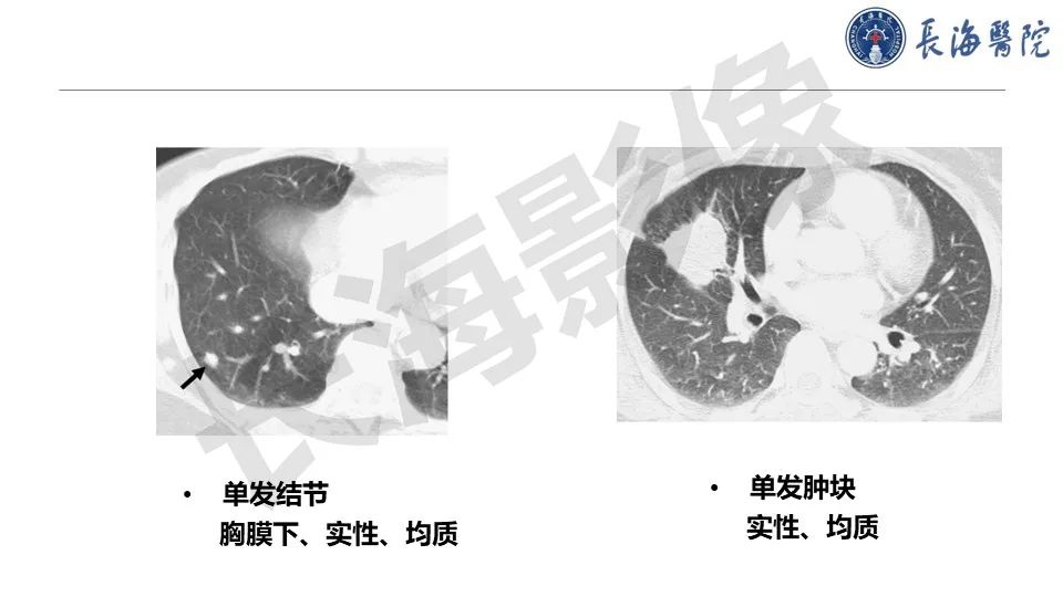 影像PPT - 【PPT】肺部隐球菌感染CT诊断-18