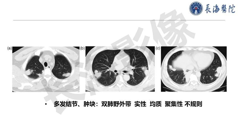 影像PPT - 【PPT】肺部隐球菌感染CT诊断-19