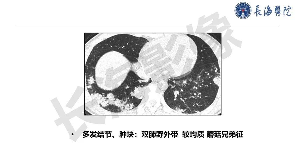 影像PPT - 【PPT】肺部隐球菌感染CT诊断-20