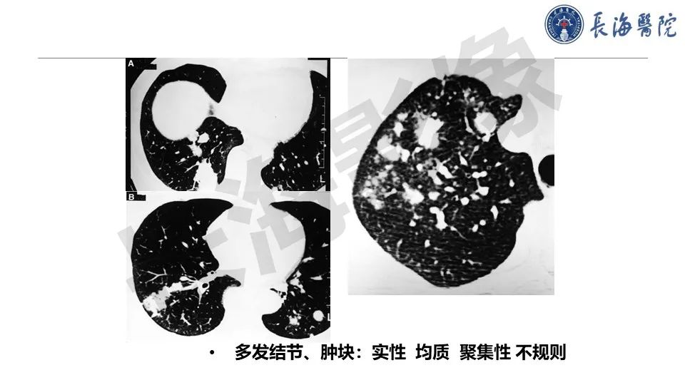 影像PPT - 【PPT】肺部隐球菌感染CT诊断-21