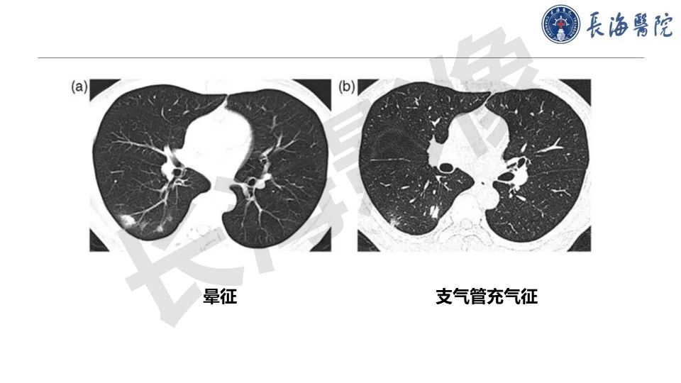 影像PPT - 【PPT】肺部隐球菌感染CT诊断-22