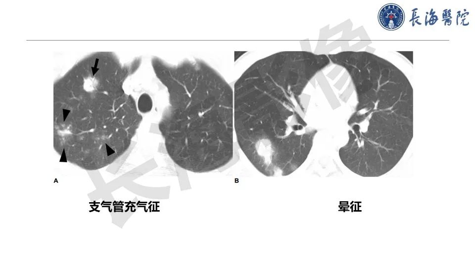影像PPT - 【PPT】肺部隐球菌感染CT诊断-23