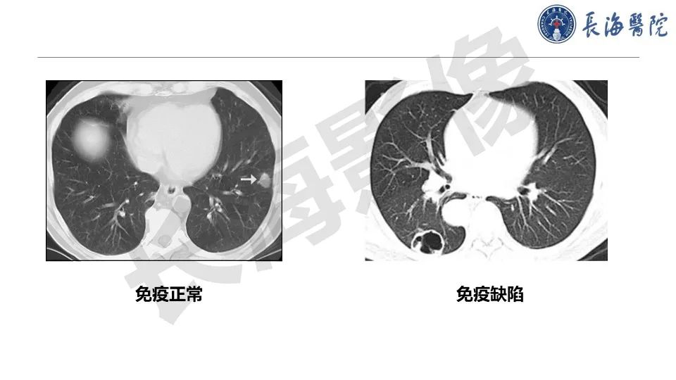 影像PPT - 【PPT】肺部隐球菌感染CT诊断-24