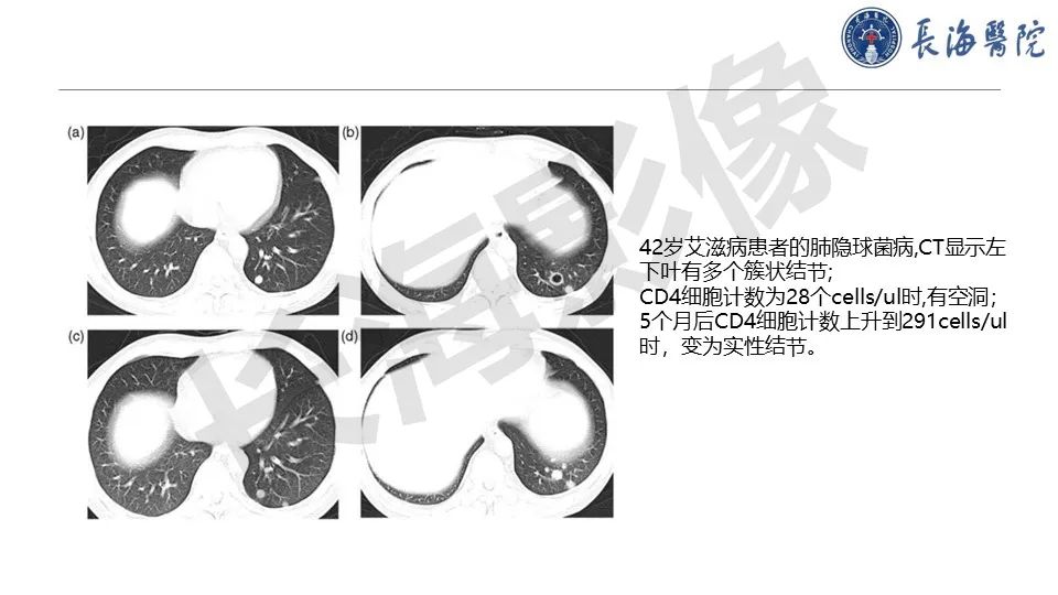 影像PPT - 【PPT】肺部隐球菌感染CT诊断-25