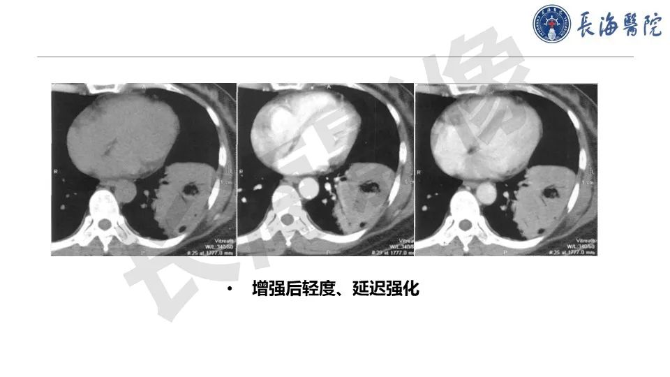 影像PPT - 【PPT】肺部隐球菌感染CT诊断-28