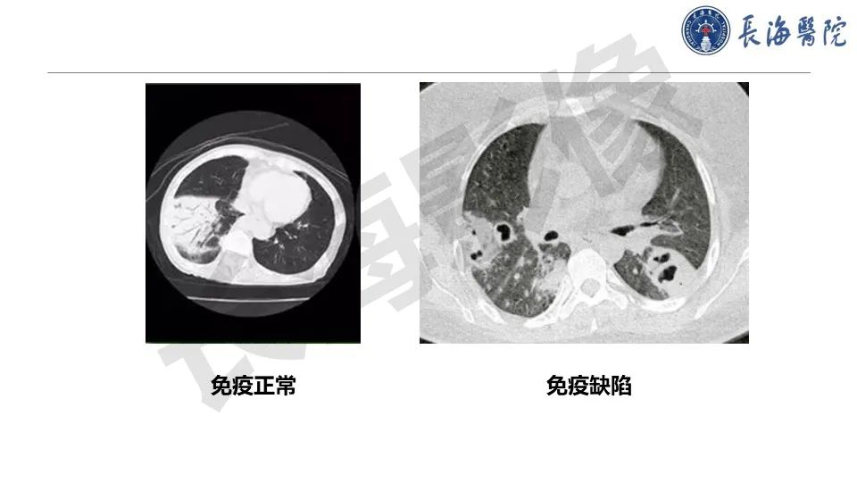 影像PPT - 【PPT】肺部隐球菌感染CT诊断-29