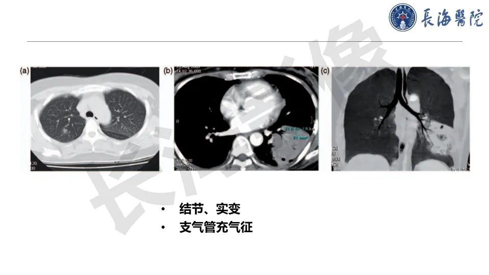 影像PPT - 【PPT】肺部隐球菌感染CT诊断-33