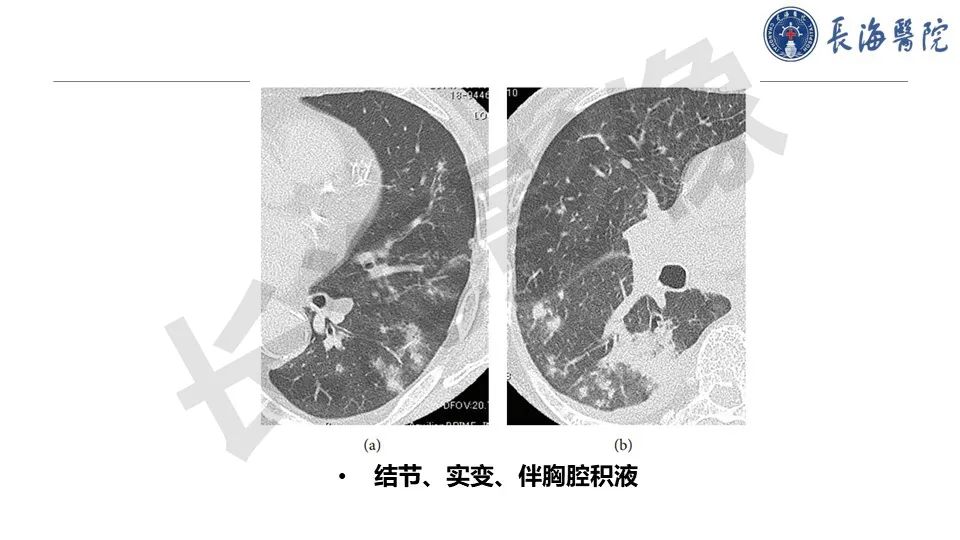 影像PPT - 【PPT】肺部隐球菌感染CT诊断-34