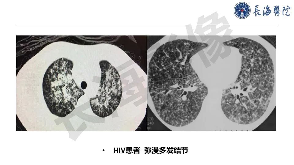 影像PPT - 【PPT】肺部隐球菌感染CT诊断-31