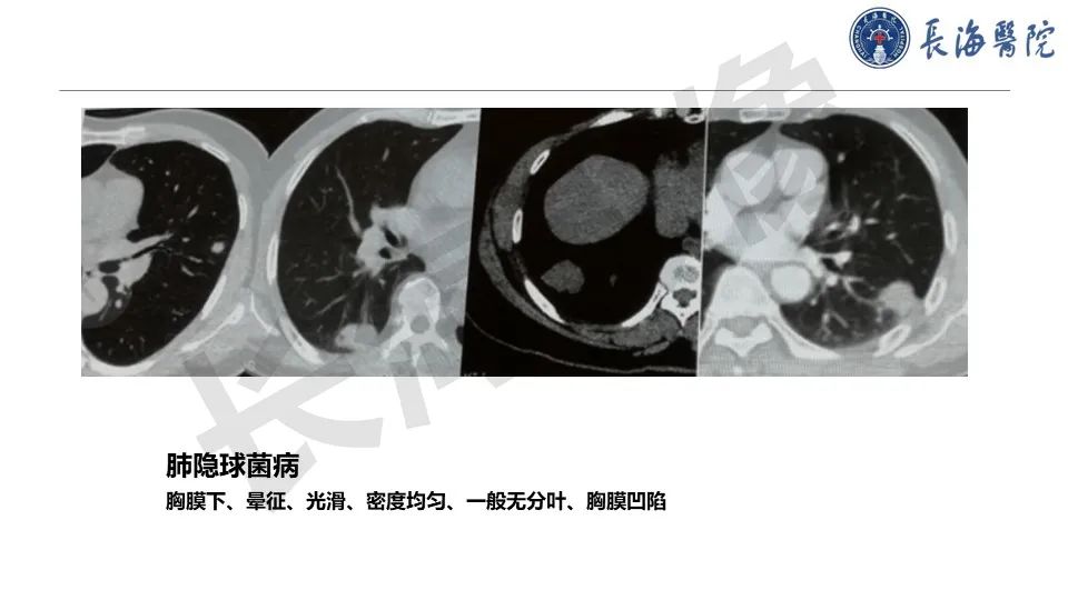 影像PPT - 【PPT】肺部隐球菌感染CT诊断-36