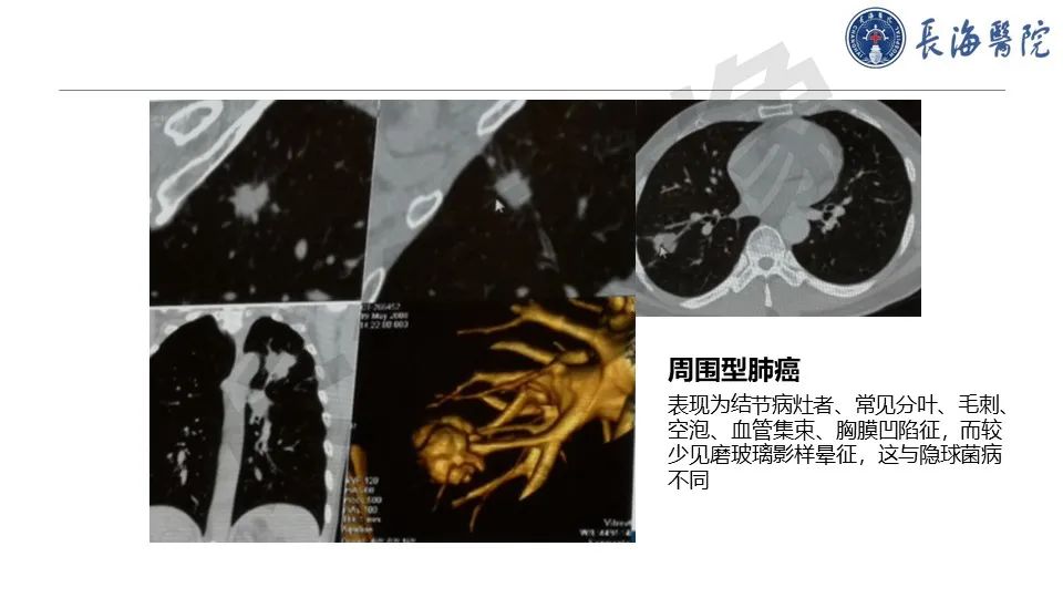 影像PPT - 【PPT】肺部隐球菌感染CT诊断-37