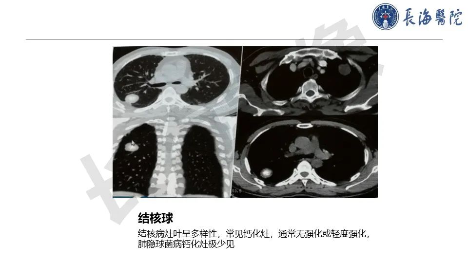 影像PPT - 【PPT】肺部隐球菌感染CT诊断-38