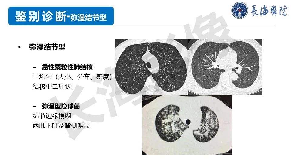 影像PPT - 【PPT】肺部隐球菌感染CT诊断-40