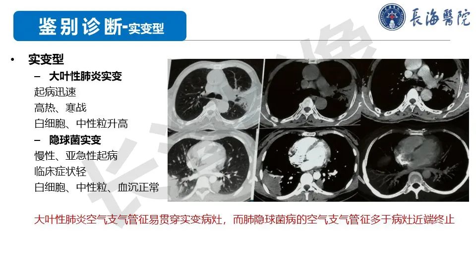 影像PPT - 【PPT】肺部隐球菌感染CT诊断-39