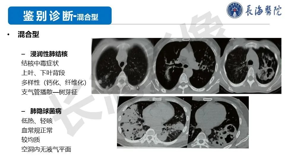 影像PPT - 【PPT】肺部隐球菌感染CT诊断-41