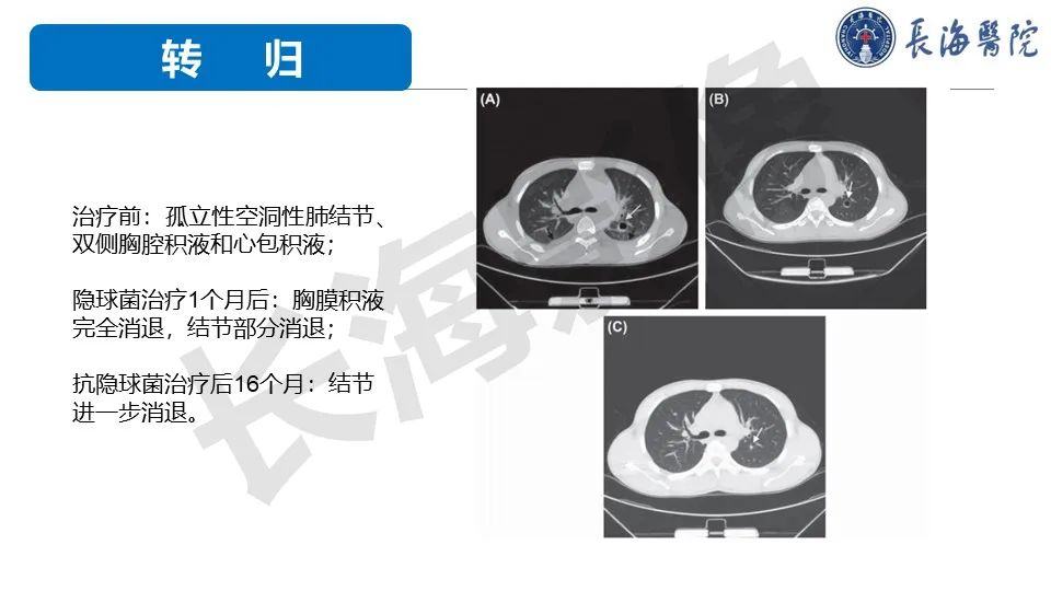影像PPT - 【PPT】肺部隐球菌感染CT诊断-42
