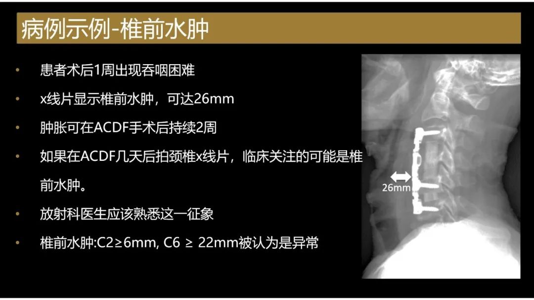 影像PPT - 【PPT】评估围手术期脊柱:除了退行性椎间盘疾病和金属植入物的并发症外-2