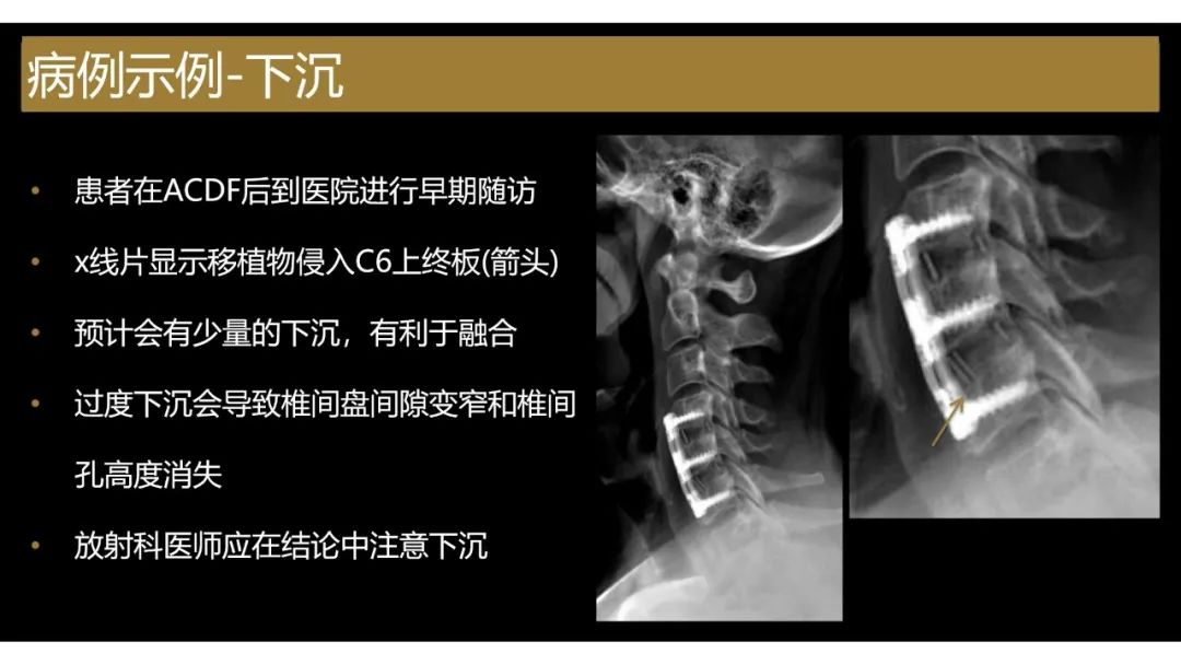 影像PPT - 【PPT】评估围手术期脊柱:除了退行性椎间盘疾病和金属植入物的并发症外-4
