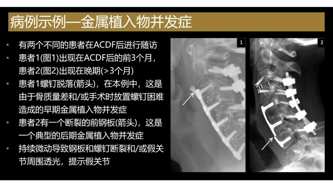 影像PPT - 【PPT】评估围手术期脊柱:除了退行性椎间盘疾病和金属植入物的并发症外-10
