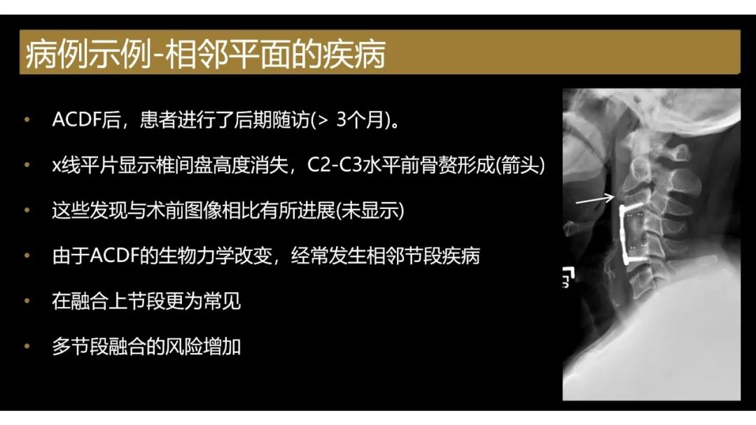 影像PPT - 【PPT】评估围手术期脊柱:除了退行性椎间盘疾病和金属植入物的并发症外-12