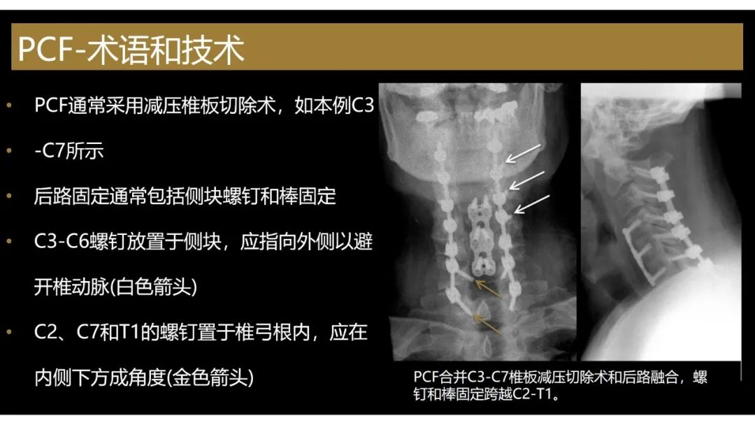 影像PPT - 【PPT】评估围手术期脊柱:除了退行性椎间盘疾病和金属植入物的并发症外-16