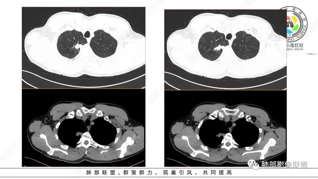 影像PPT - 【病例】少见的细支气管腺瘤1例CT影像-5 影像PPT - 【病例】少见的细支气管腺瘤1例CT影像-5