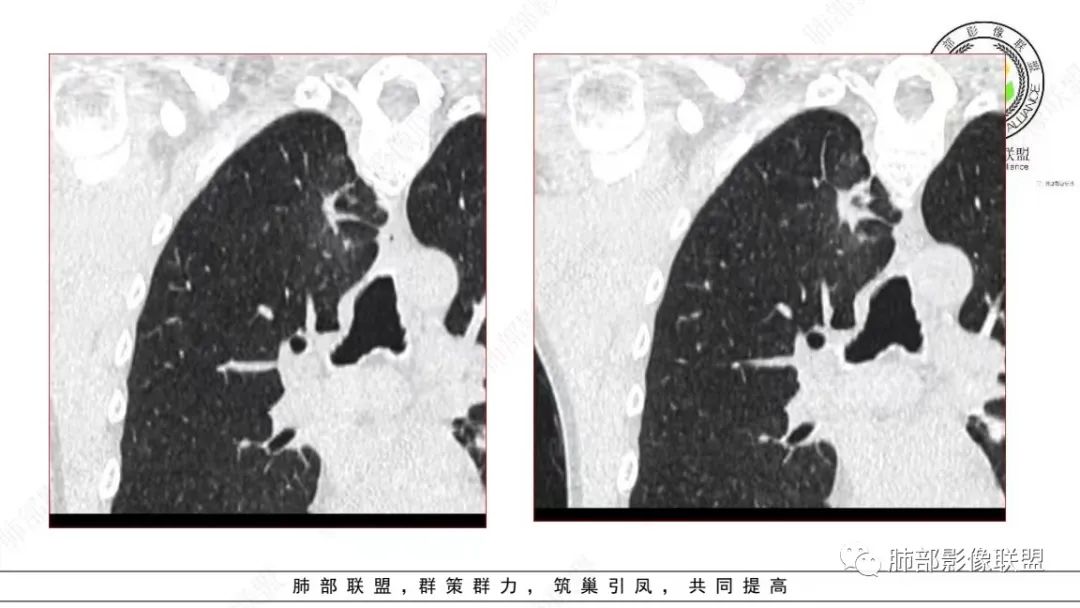 影像PPT - 【病例】少见的细支气管腺瘤1例CT影像-8 影像PPT - 【病例】少见的细支气管腺瘤1例CT影像-8